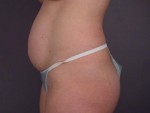 Liposuction Before and after photo