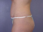 Liposuction Before and after photo