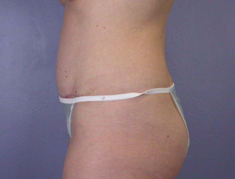 Liposuction before and after photo