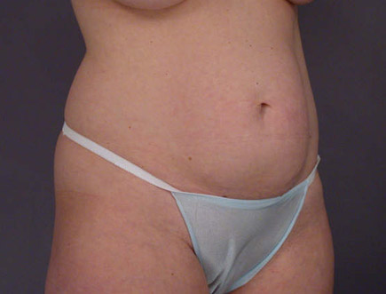 Liposuction before and after photo