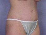 Liposuction Before and after photo