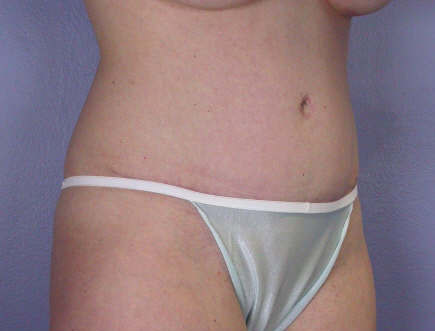 Liposuction before and after photo