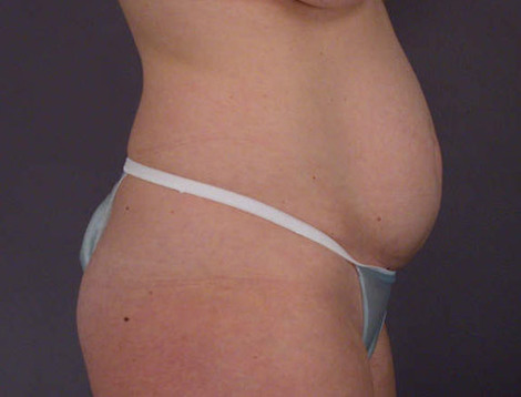 Liposuction before and after photo