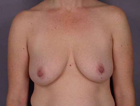 Liposuction before and after photo