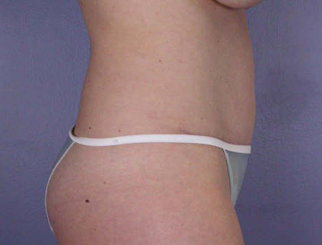 Liposuction before and after photo