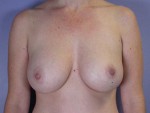 Liposuction Before and after photo