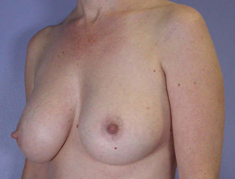 Liposuction before and after photo