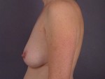 Liposuction Before and after photo