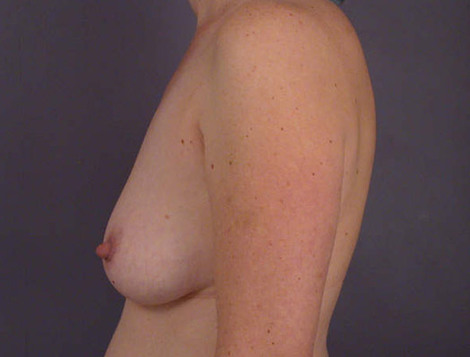 Liposuction before and after photo