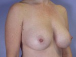 Liposuction Before and after photo