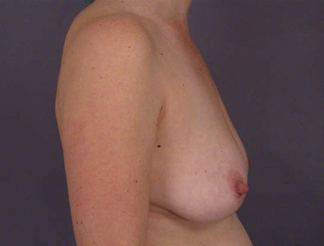 Liposuction before and after photo