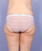 Tummy Tuck Before and after photo