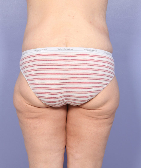 Tummy Tuck before and after photo