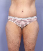 Tummy Tuck Before and after photo