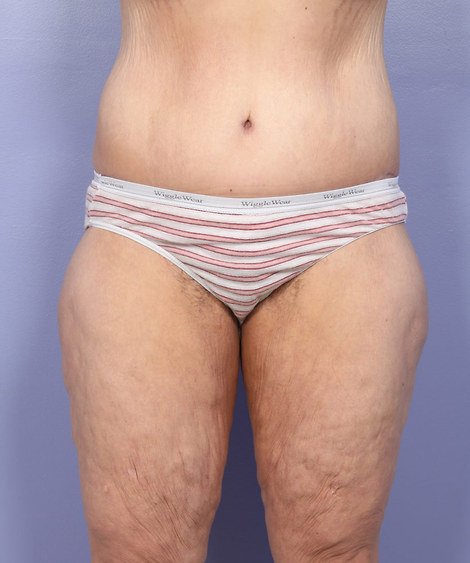 Tummy Tuck before and after photo