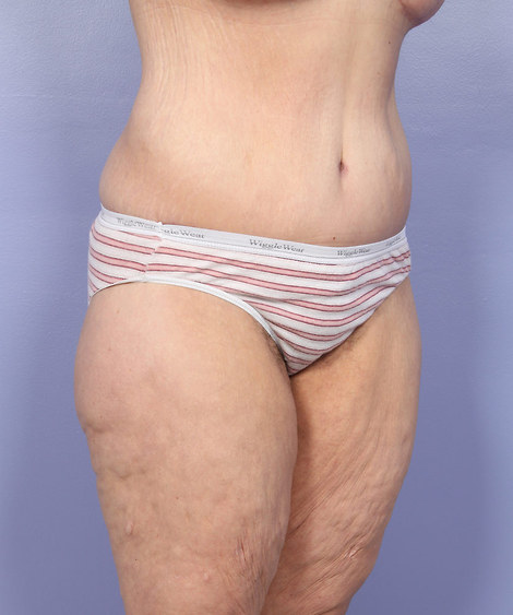 Tummy Tuck before and after photo