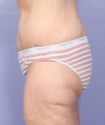 Tummy Tuck Before and after photo