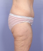 Tummy Tuck Before and after photo