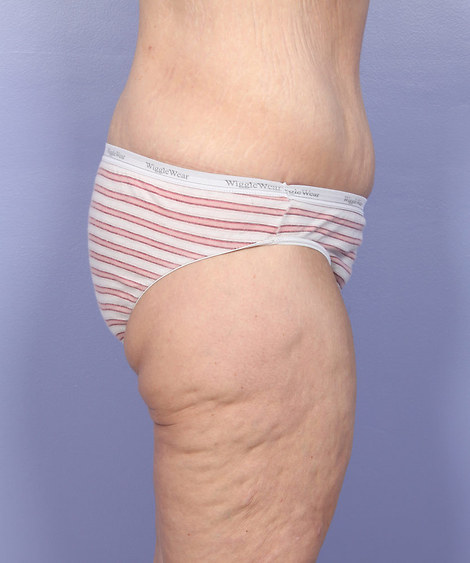 Tummy Tuck before and after photo