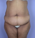 Tummy Tuck Before and after photo