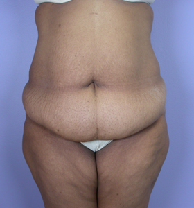 Tummy Tuck before and after photo