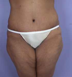 Tummy Tuck before and after photo