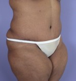 Tummy Tuck Before and after photo