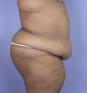 Tummy Tuck before and after photo