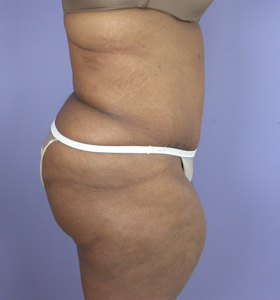 Tummy Tuck before and after photo