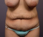 Tummy Tuck Before and after photo