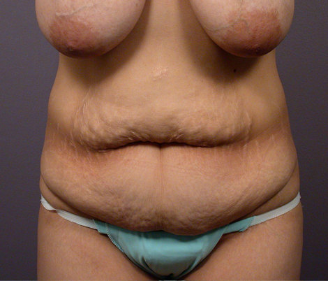 Tummy Tuck before and after photo