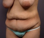 Tummy Tuck Before and after photo