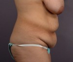 Tummy Tuck Before and after photo