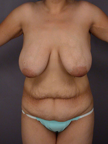 Tummy Tuck before and after photo