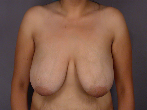 Tummy Tuck before and after photo