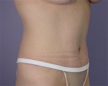 Tummy Tuck before and after photo