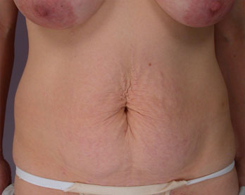 Tummy Tuck before and after photo