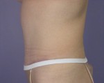 Tummy Tuck Before and after photo