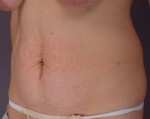 Tummy Tuck Before and after photo