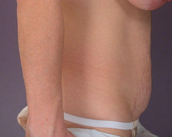 Tummy Tuck before and after photo