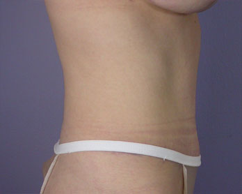 Tummy Tuck before and after photo