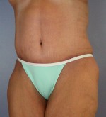 Tummy Tuck Before and after photo