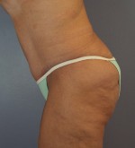 Tummy Tuck Before and after photo