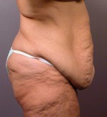 Tummy Tuck Before and after photo