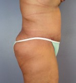 Tummy Tuck Before and after photo