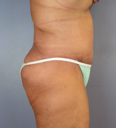 Tummy Tuck before and after photo