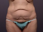 Tummy Tuck Before and after photo