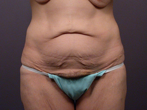 Tummy Tuck before and after photo