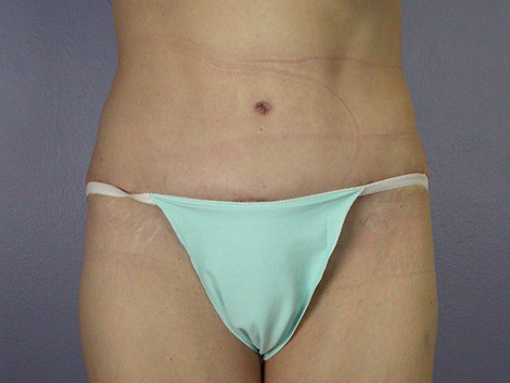 Tummy Tuck before and after photo