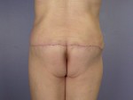 Tummy Tuck Before and after photo